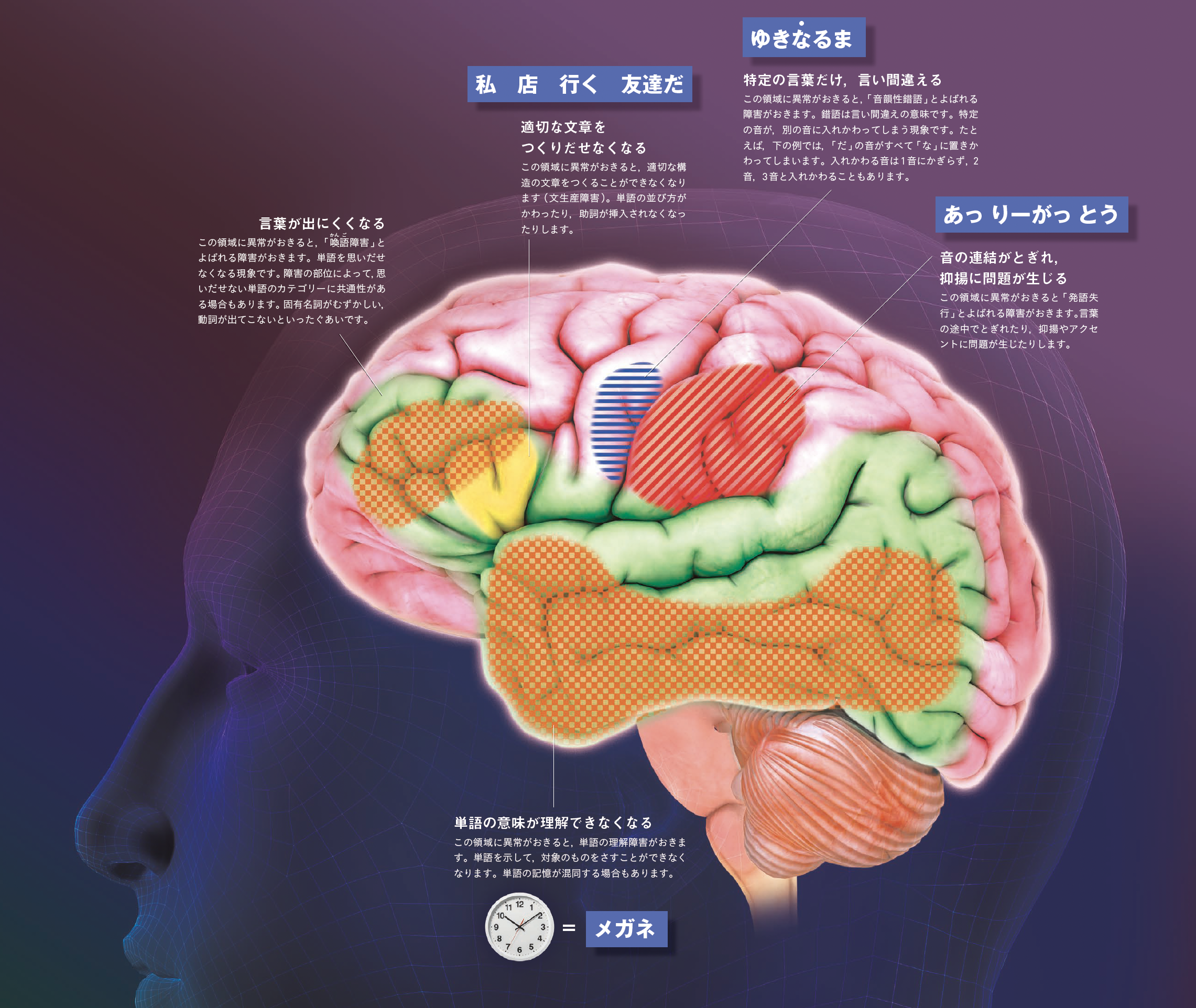 【言語】文章がうまく話せない。文の構造が理解できなくなる