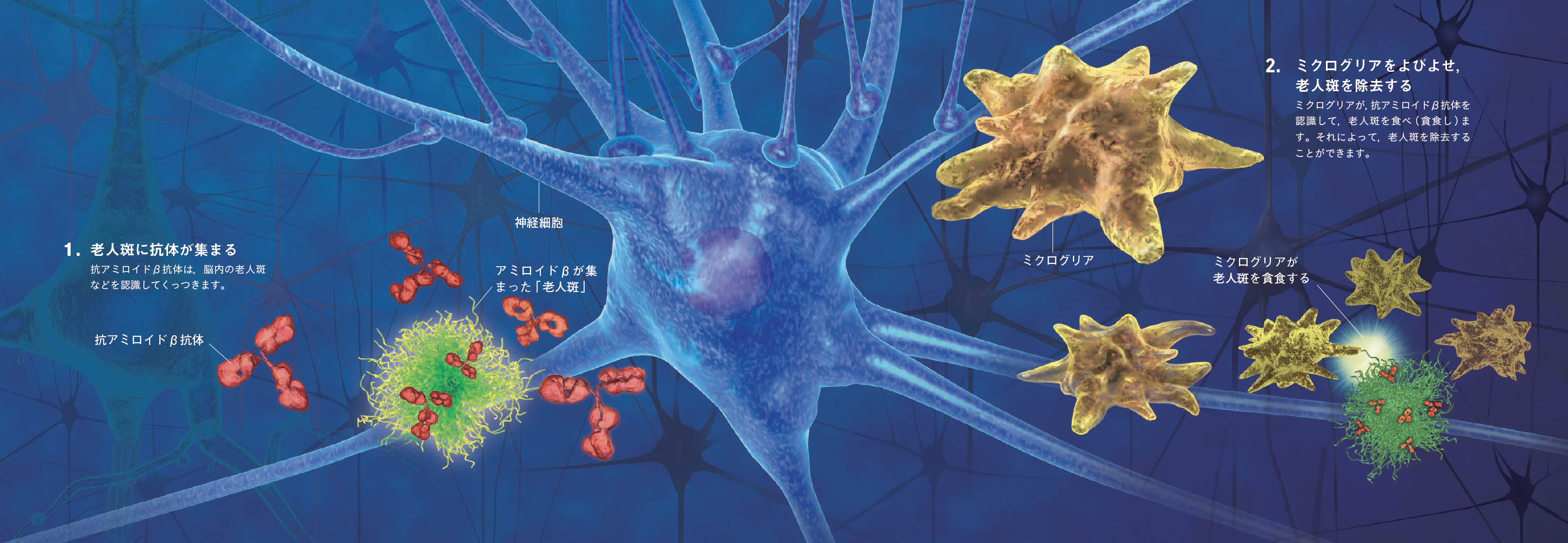 【治療と遺伝】蓄積するタンパク質をいかに減らすか。認知症の種類に合わせた薬の開発が進む