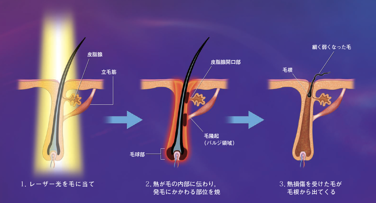 【医療脱毛】低出力のレーザーをくりかえし毛に当てることで，痛みの少ない「脱毛」が可能に