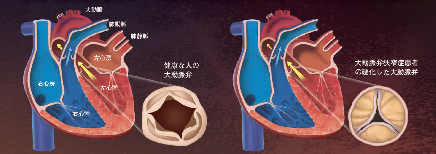 【大動脈弁狭窄症】硬化した心臓弁にかわり，新しい生体弁を留置する最新カテーテル手術